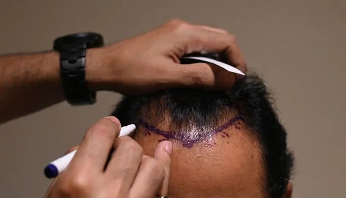 Affordable Hair Transplant Turkey at Sapphire Hair Clinic