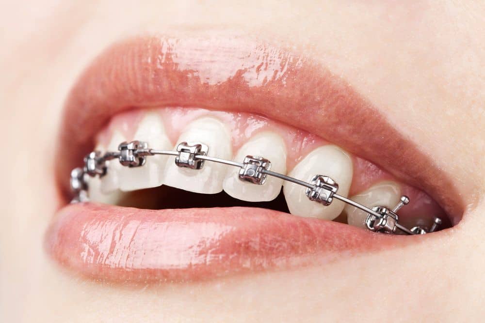 Achieving a Beautiful Smile at Level Orthodontics North